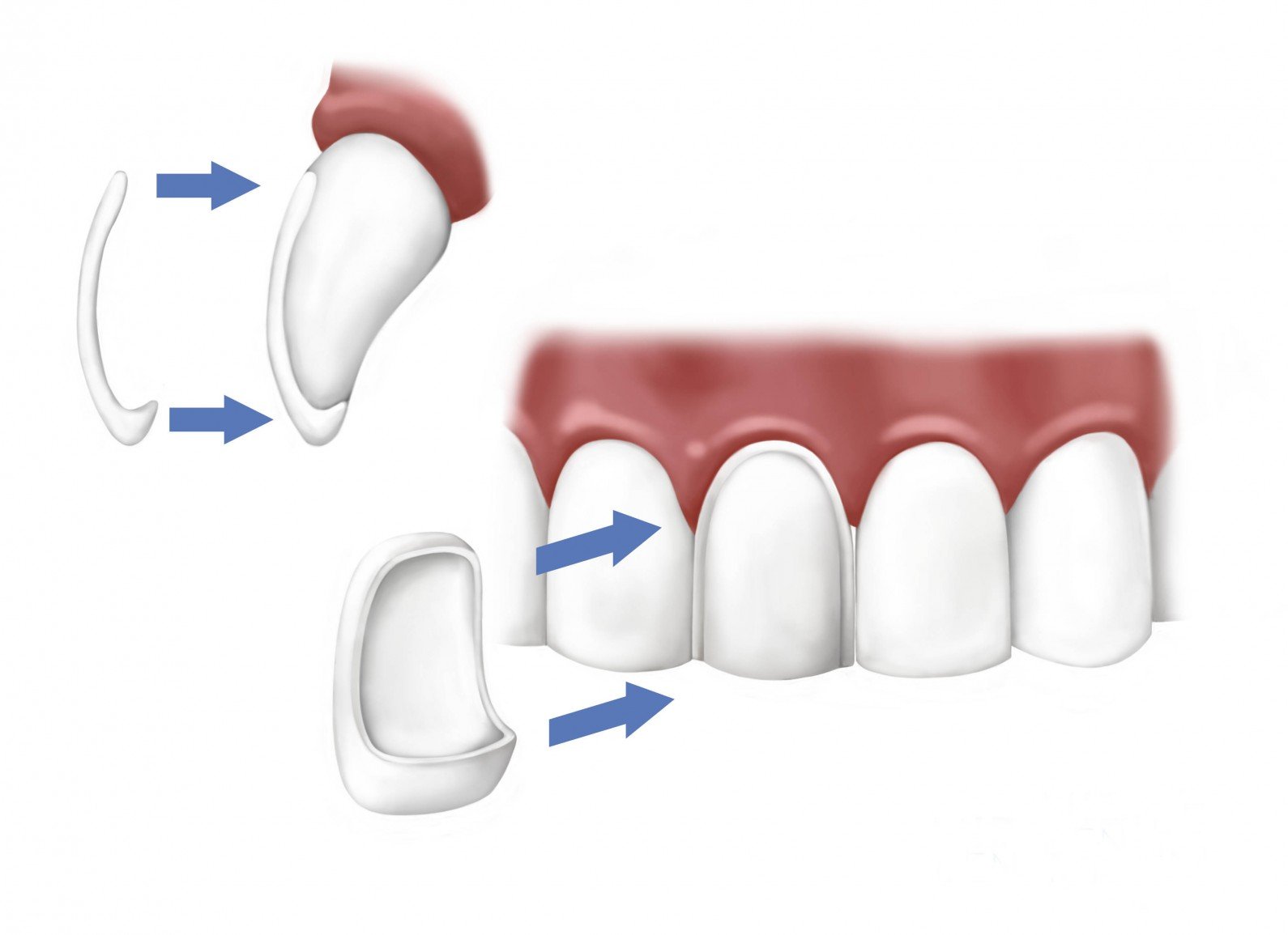 tooth veneers